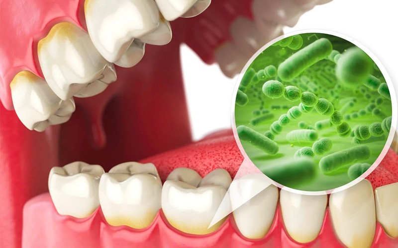 Señales de alerta de la aparición de bacterias en la boca
