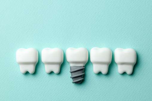 Perdida de dientes : Implante Dental